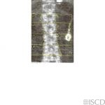 Bariatric Surgery Lap Band Artifact