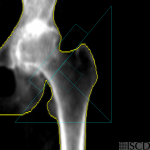 Hip Osteoarthritis - How Bad Can It Get?