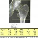 Benign Bone Lesions - Bone Infarct
