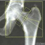 Calcified Tendon
