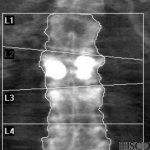 Vertebral Augmentation