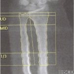 Motion Artifact/Tremor