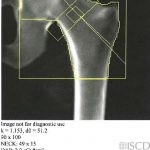 Left Greater Trochanter Fracture