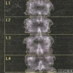 Spinal Level Identification