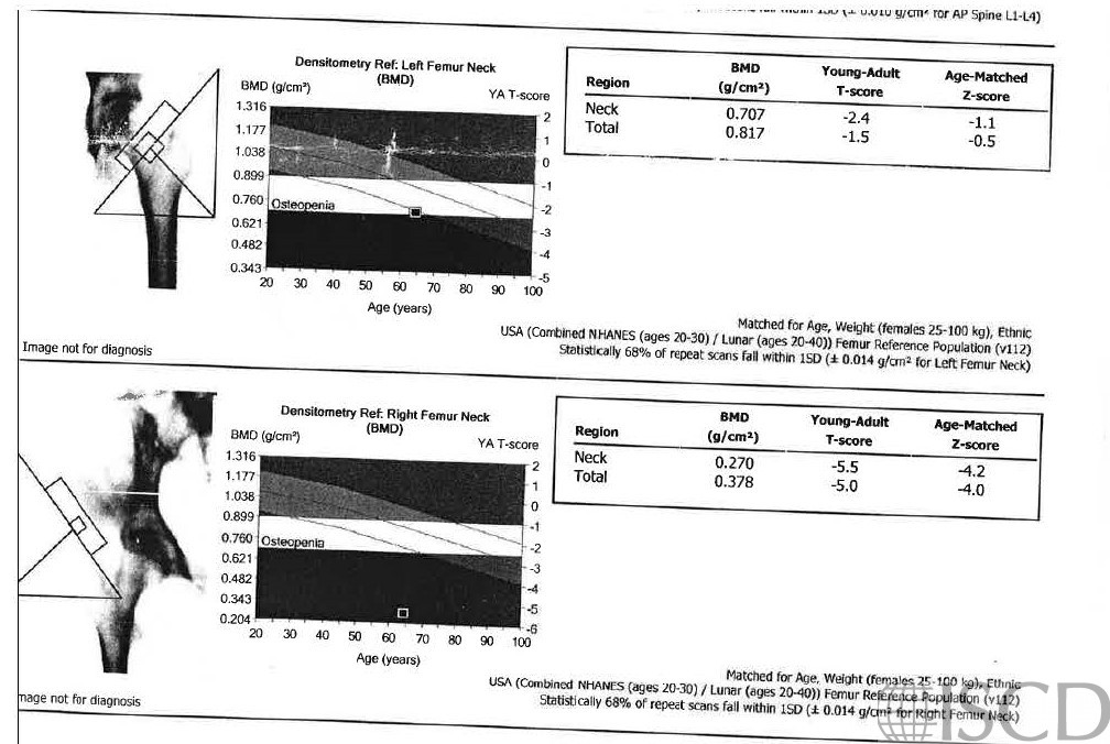 Incorrect GE Hip Analysis - ISCD