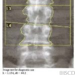Differences in Spine Region of Interest Size Over Time