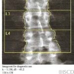 Change of Size of Lumbar Spine Region of Interest Over Time