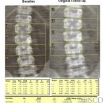 Difference in Spinal Levels on Follow-up Scan