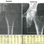 Femoral Neck Size Different Between Baseline and Follow-up Scan