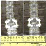 Effects of Spinal Hardware on Spine DXA Analysis