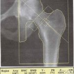 Hologic Hip Global Region of Interest Incorrect