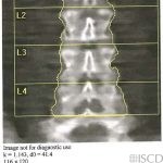 5 Lumbar Vertebral Bodies with Lowest Ribs on T11 vs. 6 Lumbar Vertebral Bodies