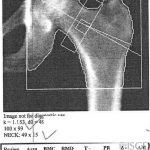 Incorrect Femoral Neck Positioning and Analysis/Hologic