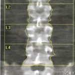 Normal Hologic Spine Scan
