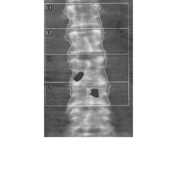 Normal Anterior-Posterior (AP) Lumbar Spine Scan from a GE iDXA ...