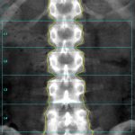 Normal Anterior-Posterior (AP) Lumbar Spine Scan from a GE iDXA Densitometer