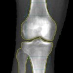 Capturing BMD of the Distal Femur and Proximal Tibia utilizing GE Orthopedic Knee Software