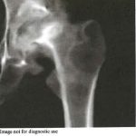 Chronic Malunited Left Subcapital Femoral Fracture