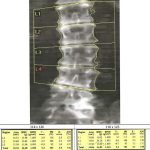 Incorrect Size of Lumbar Spine Region of Interest on A Hologic Lumbar Spine Scan